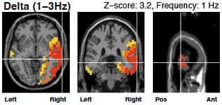 Delta wave brain scan before neurofeedback therapy